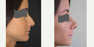 Rhinoplasty before and after photo