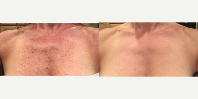 BroadBand Light (BBL) before and after photo