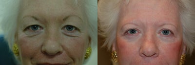Eyelid Surgery before and after photo