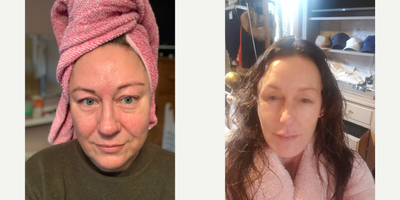 Microneedling before and after photo