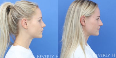 Rhinoplasty before and after photo