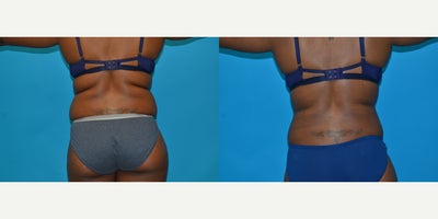 Smart Lipo before and after photo
