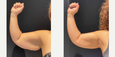 Arm Lift before and after photo