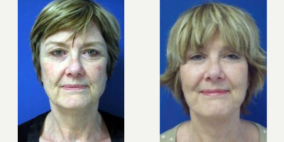 Facelift before and after photo