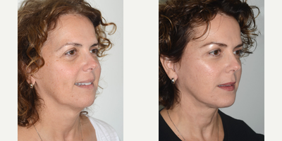 Facelift before and after photo