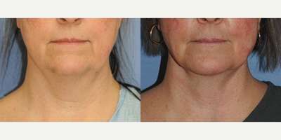 Facelift before and after photo