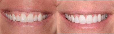Porcelain Veneers before and after photo
