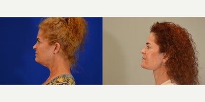 Deep Plane Facelift before and after photo