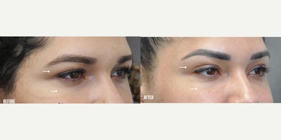 Dermal Fillers before and after photo