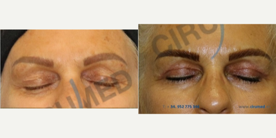 Eyelid Surgery before and after photo