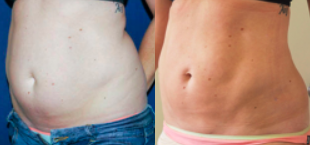 Liposuction before and after photo