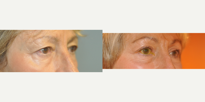 Ptosis Surgery before and after photo