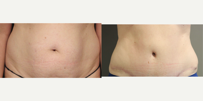 Tummy Tuck before and after photo