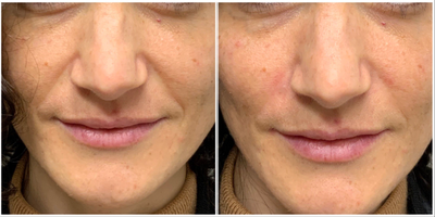 Voluma before and after photo