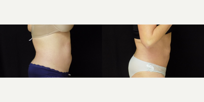CoolSculpting before and after photo