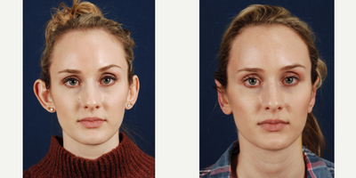 Ear Surgery before and after photo
