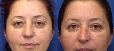Eyelid Surgery before and after photo