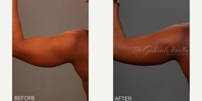 Liposuction before and after photo
