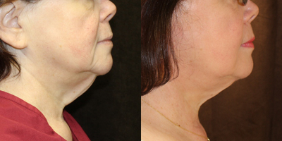 Neck Lift before and after photo