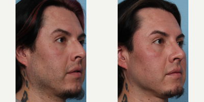 Rhinoplasty before and after photo