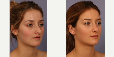 Rhinoplasty before and after photo