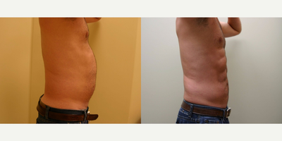 Abdominal Etching before and after photo