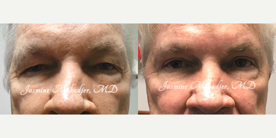 Brow Lift before and after photo