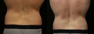 CoolSculpting before and after photo