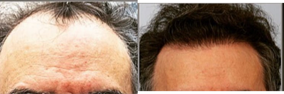 Hair Transplant before and after photo