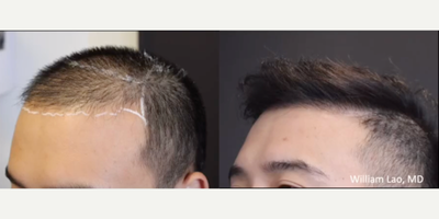 Hair Transplant before and after photo