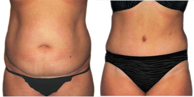 Tummy Tuck before and after photo