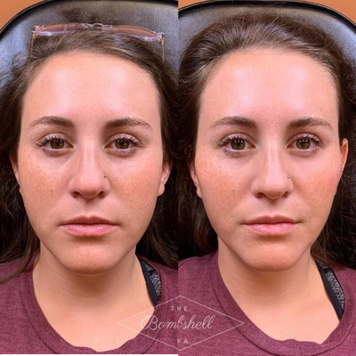Dermal Fillers before and after photo
