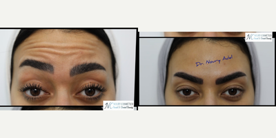 Dysport before and after photo