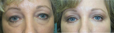 Eyelid Surgery before and after photo
