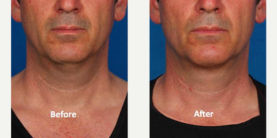 Kybella before and after photo