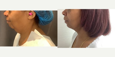 before and after image