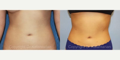Liposuction before and after photo