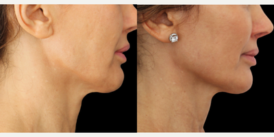 Profound RF before and after photo