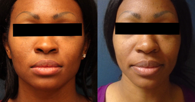 Rhinoplasty before and after photo