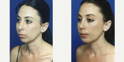 Rhinoplasty before and after photo