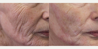 Thread Lift before and after photo