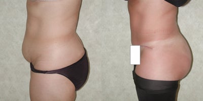 Tummy Tuck before and after photo