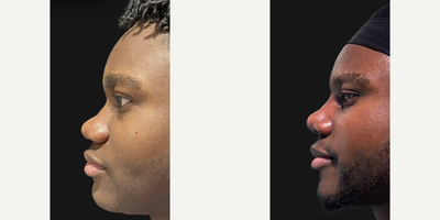 African American Rhinoplasty before and after photo