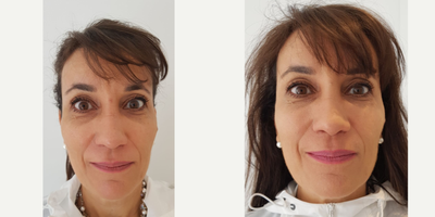 Dermal Fillers before and after photo