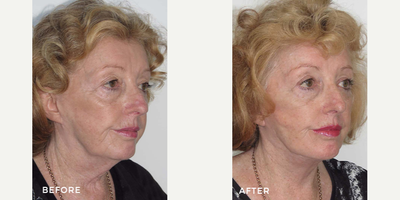 Facelift before and after photo