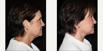Facelift before and after photo