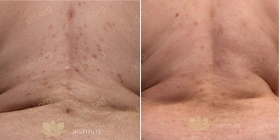 Laser Resurfacing before and after photo