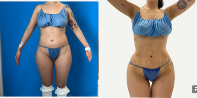 Liposculpture before and after photo