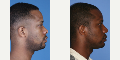 African American Rhinoplasty before and after photo