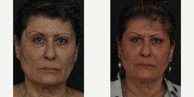 Eyelid Surgery before and after photo
